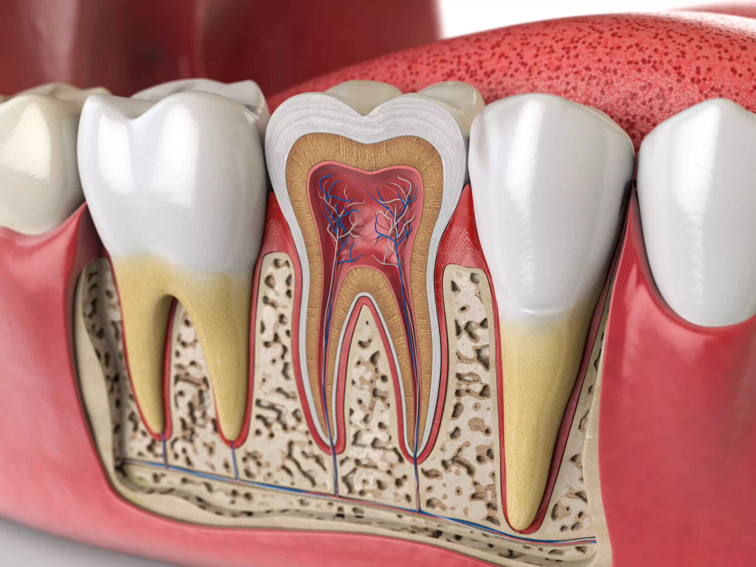 Querschnitt eines Zahns zur Verdeutlichung von Zahnentzündung